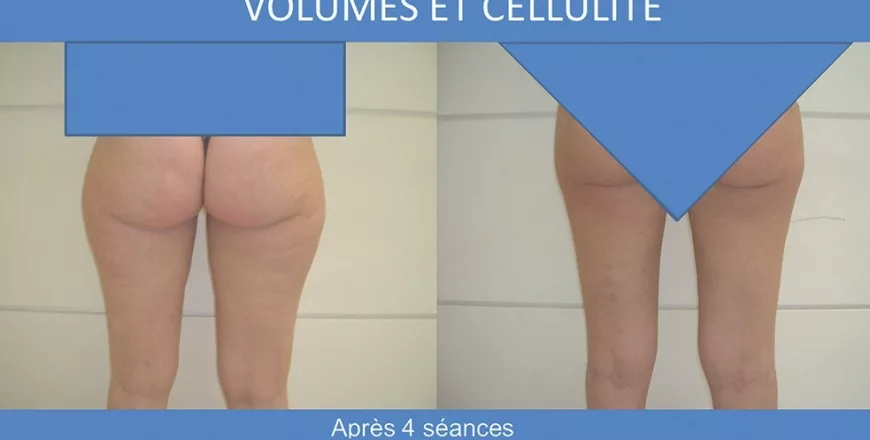 cellulite et cryothérapie avant après